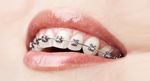 Ortodonti Tedavisi